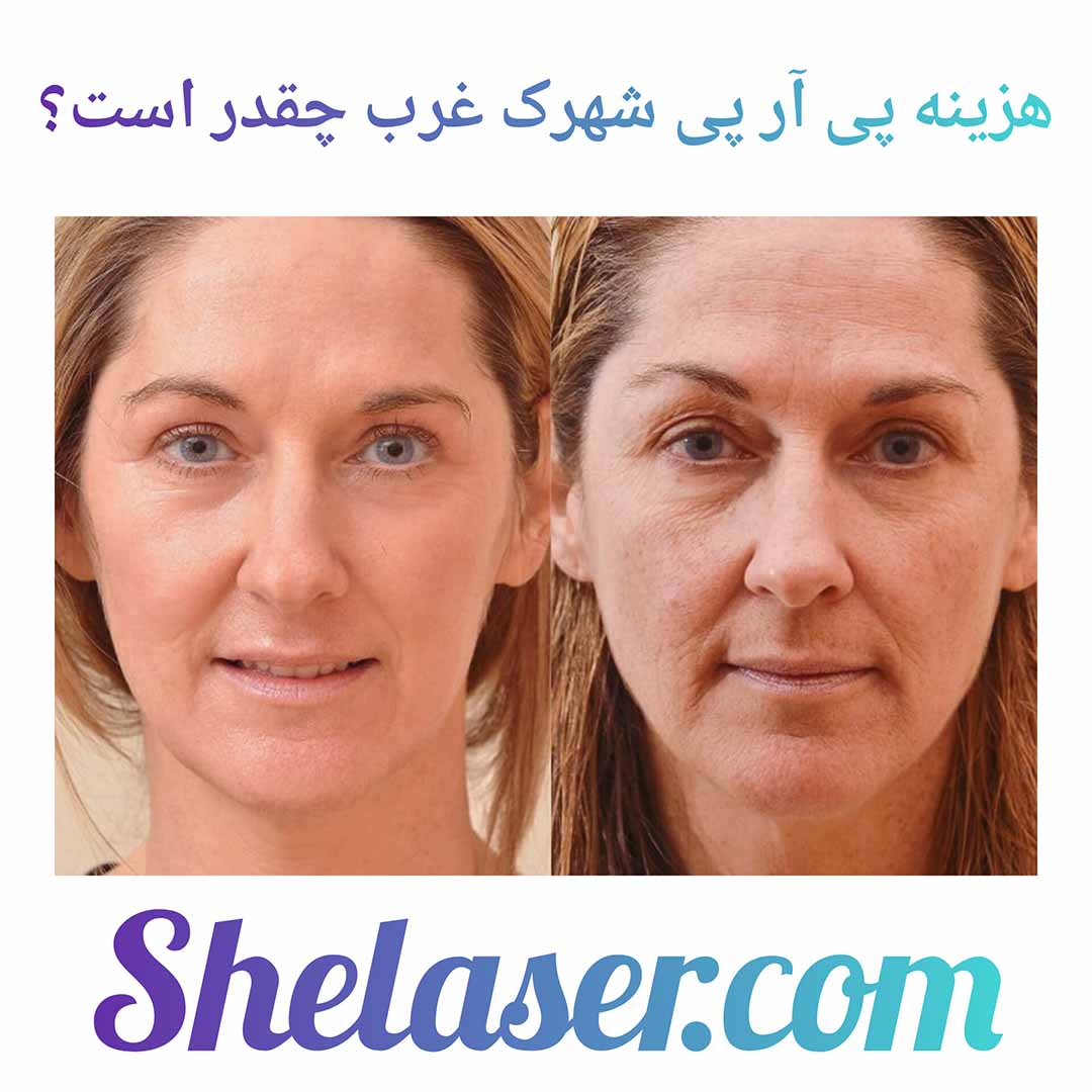 هزینه پی آر پی شهرک غرب چقدر است؟