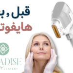 عکس قبل و بعد هایفوتراپی