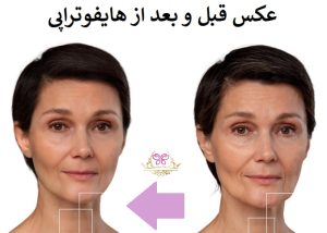 عکس قبل و بعد از هایفوتراپی