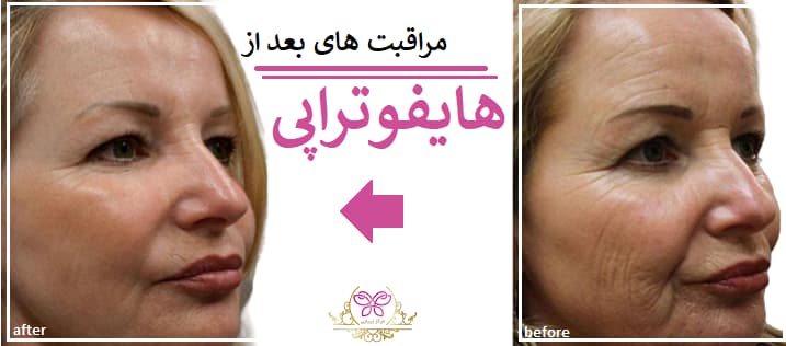 مراقبت های بعد از هایفوتراپی