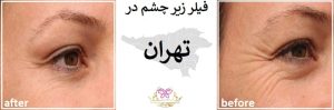 فیلر زیر چشم در تهران