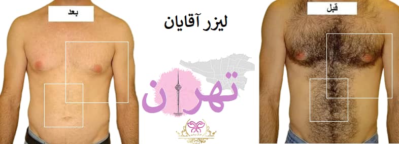 لیزر آقایان تهران