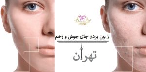 از بین بردن جای جوش و زخم در تهران