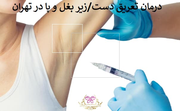 درمان تعریق دست/زیر بغل و پا در تهران