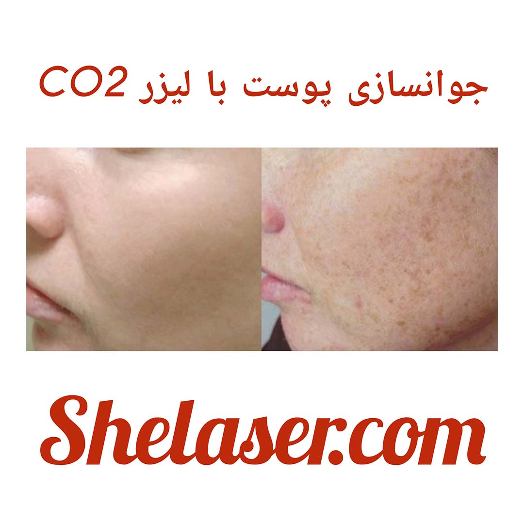 جوانسازی پوست با لیزر CO2