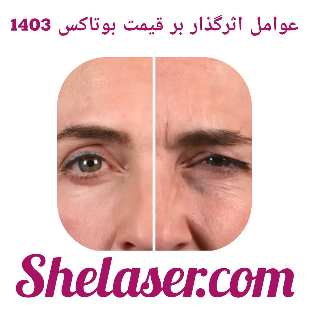 عوامل اثرگذار بر قیمت بوتاکس 1403