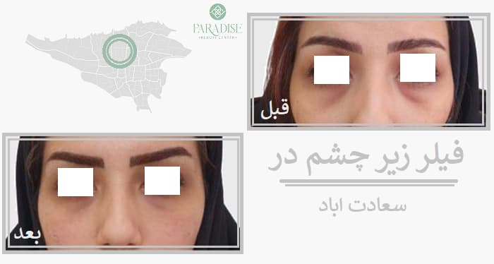 فیلر زیر چشم در سعادت اباد