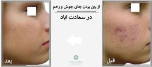 از بین بردن جای جوش و زخم در سعادت اباد