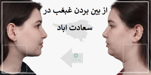 از بین بردن غبغب در سعادت اباد