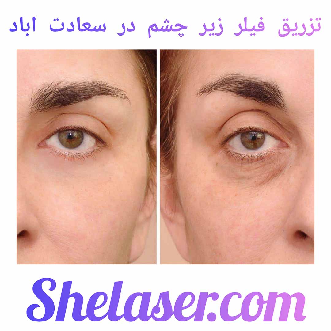 تزریق فیلر زیر چشم در سعادت اباد