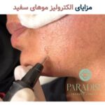 مزایای الکترولیز موهای سفید