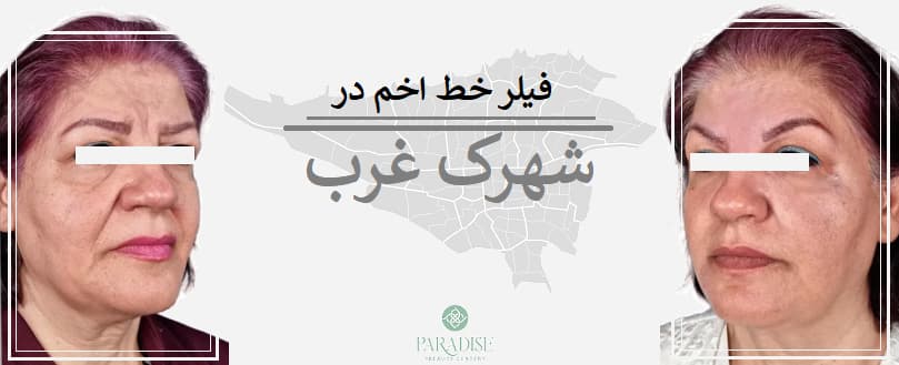 فیلر خط اخم در شهرک غرب