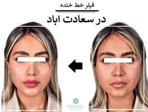 فیلر خط خنده در سعادت اباد