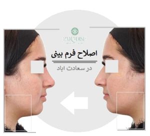 اصلاح فرم بینی در سعادت اباد