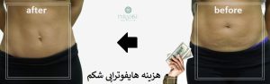 هزینه هایفوتراپی شکم