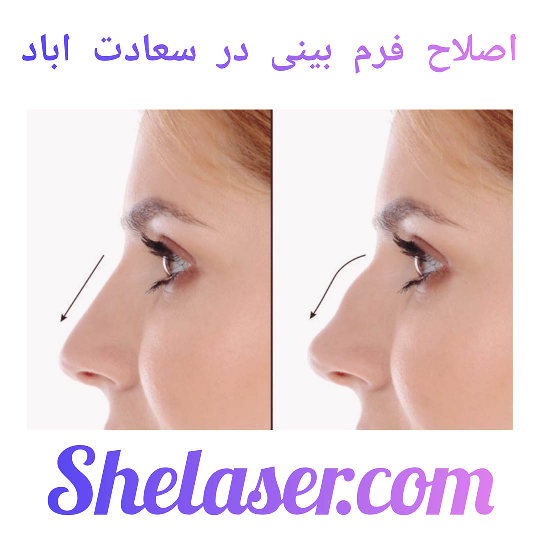 اصلاح فرم بینی در سعادت اباد