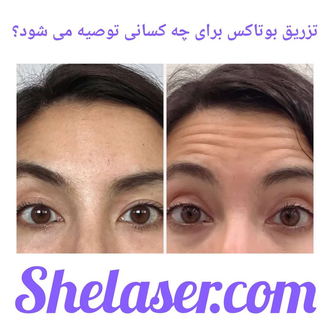 تزریق بوتاکس برای چه کسانی توصیه می شود؟