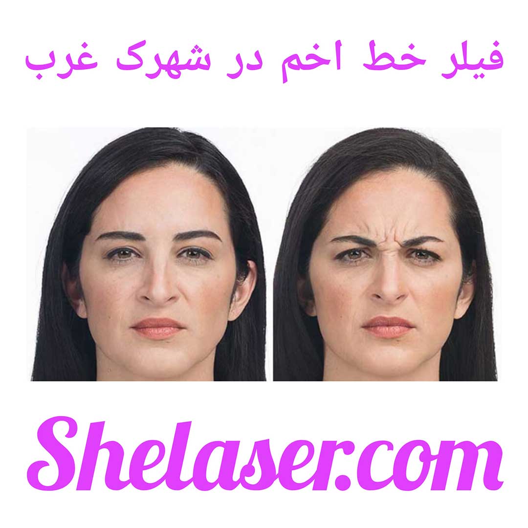 فیلر خط اخم در شهرک غرب