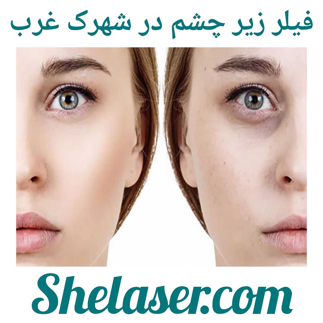 فیلر زیر چشم در شهرک غرب