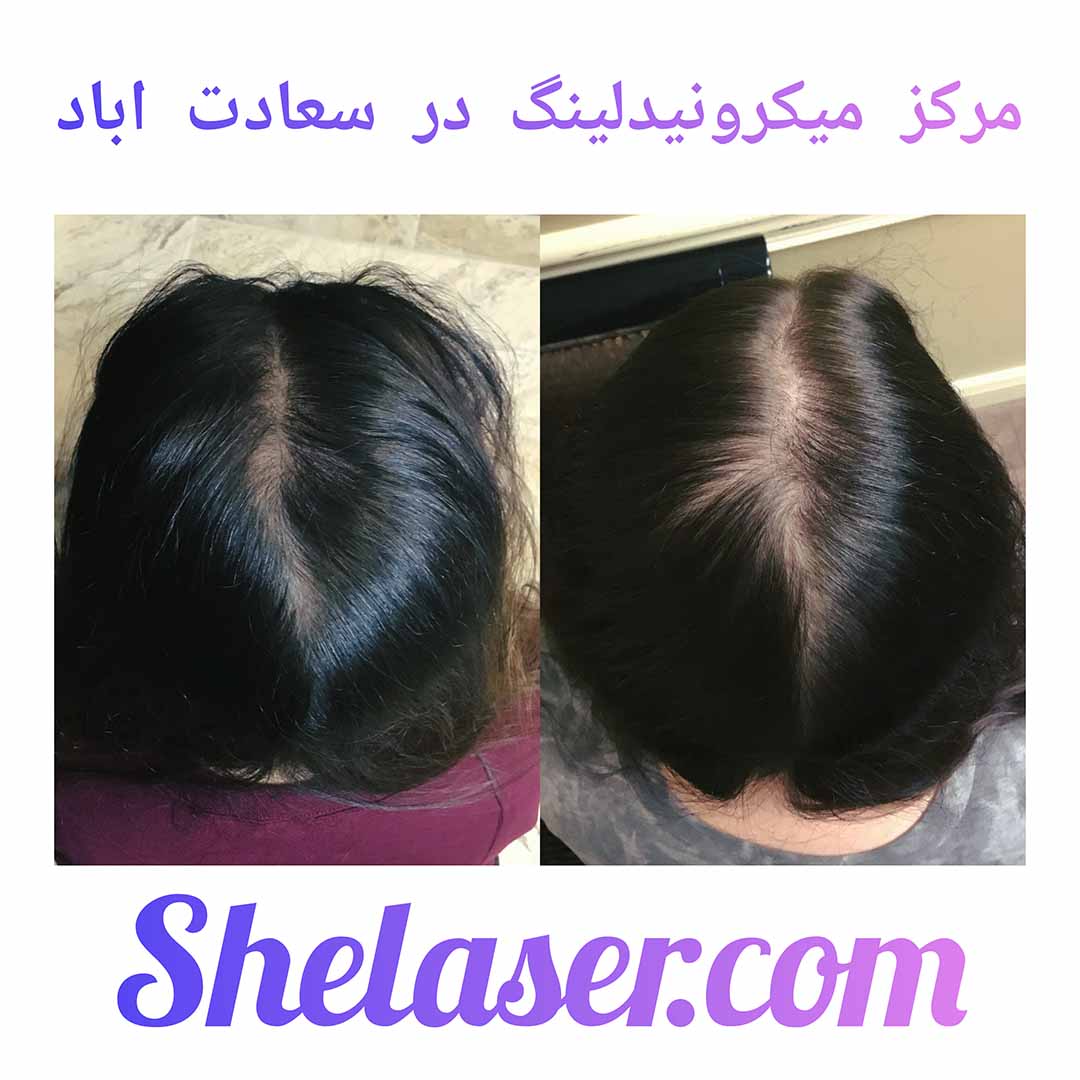 مرکز میکرونیدلینگ در سعادت اباد