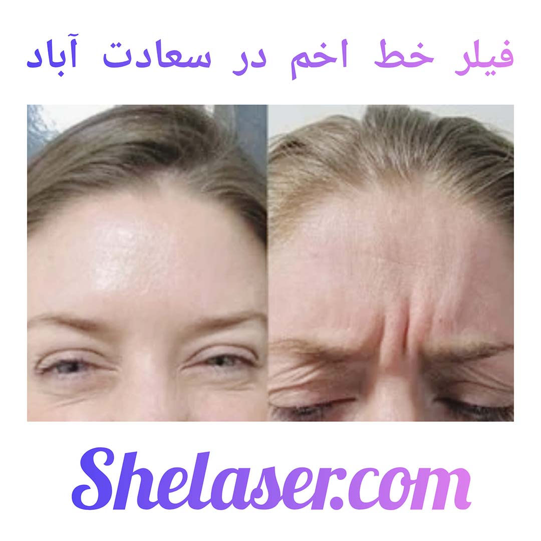 فیلر خط اخم در سعادت آباد