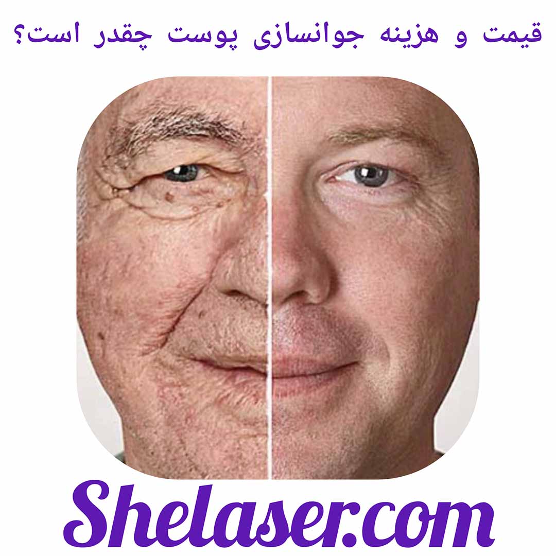 قیمت و هزینه جوانسازی پوست چقدر است؟