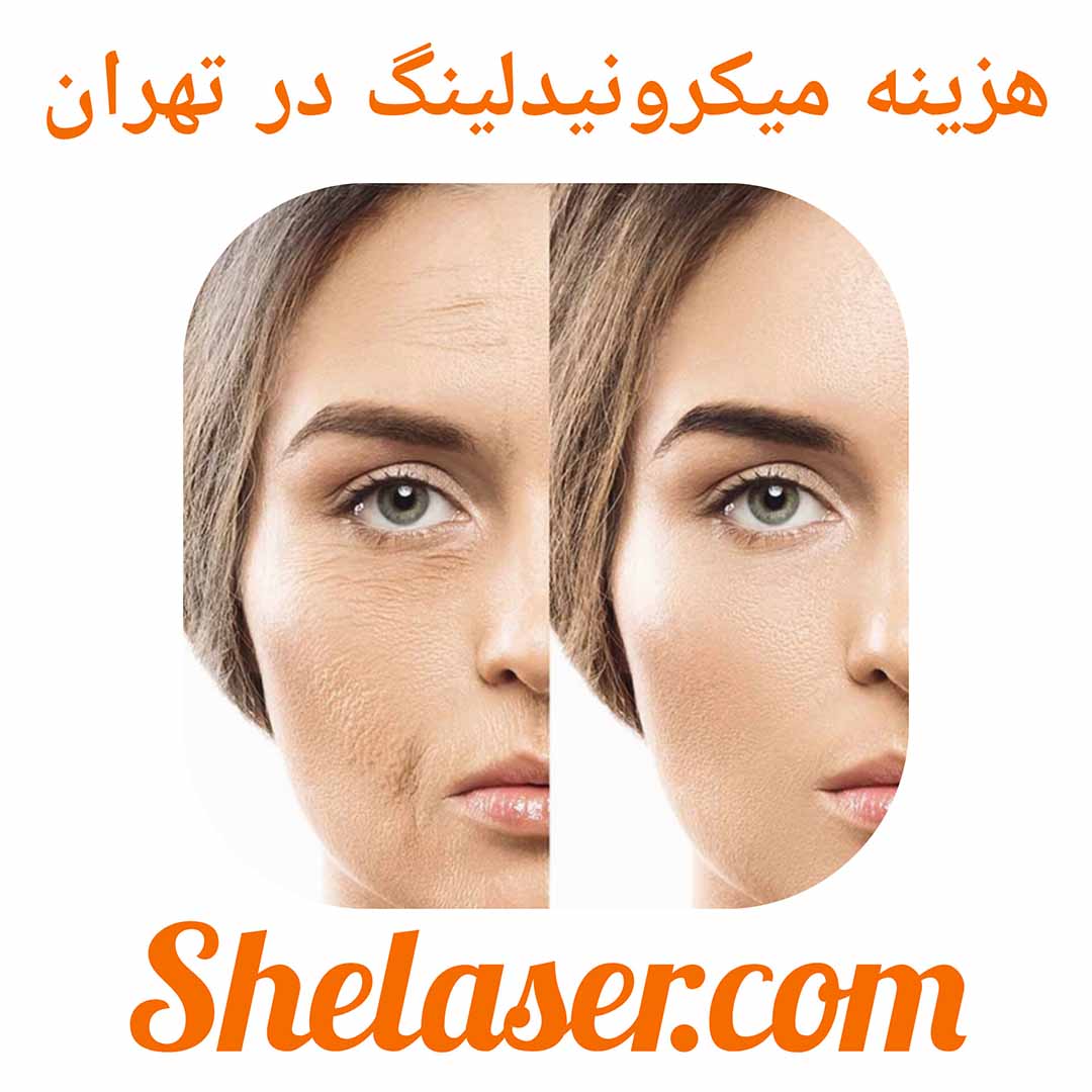 هزینه میکرونیدلینگ در تهران