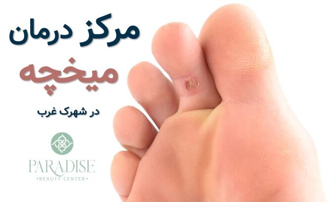 درمان میخچه در شهرک غرب