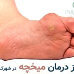 بهترین مرکز درمان میخچه