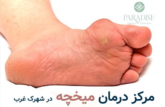 بهترین مرکز درمان میخچه