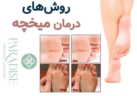 روش های درمان میخچه