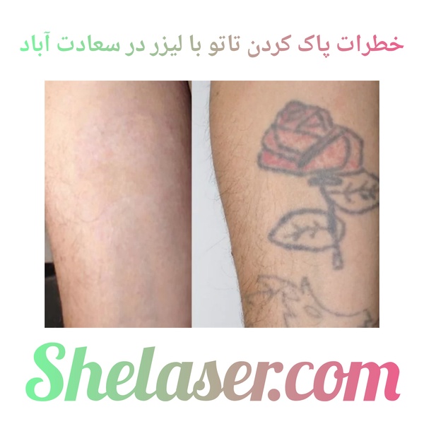 خطرات پاک کردن لیزر تاتو در سعادت آباد