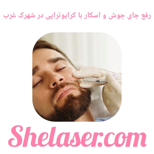 رفع جای جوش و اسکار با کرایوتراپی در شهرک غرب