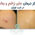 مرکز درمان جای زخم و بخیه در غرب تهران