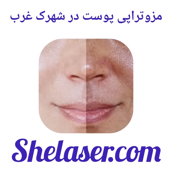 مزوتراپی پوست در شهرک غرب