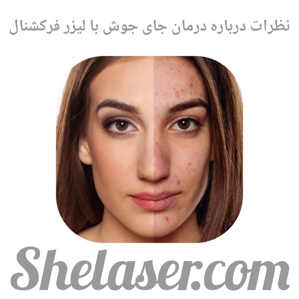 نظرات درباره درمان جای جوش با لیزر فرکشنال