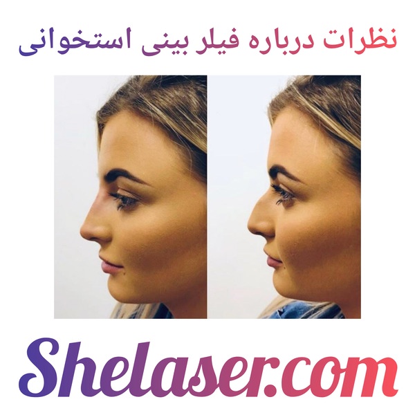 نظرات درباره فیلر بینی استخوانی