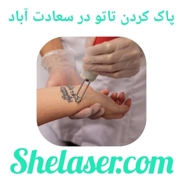 پاک کردن تاتو در سعادت آباد