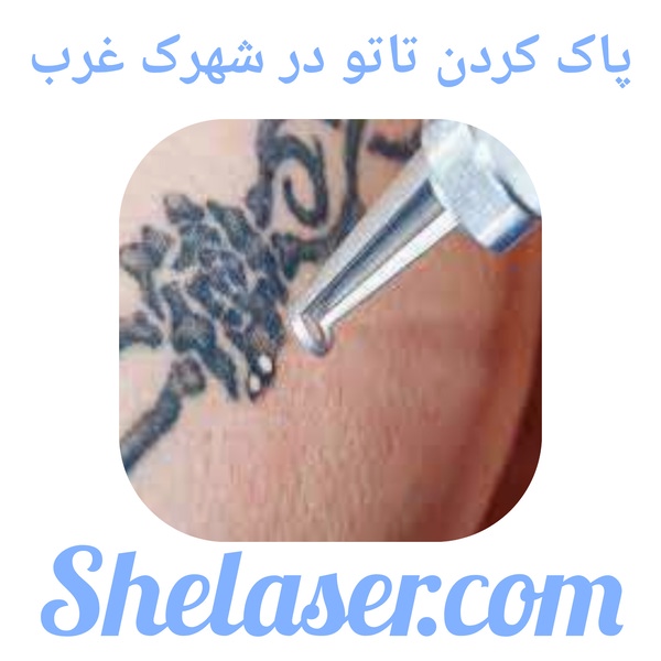 پاک کردن تاتو در شهرک غرب