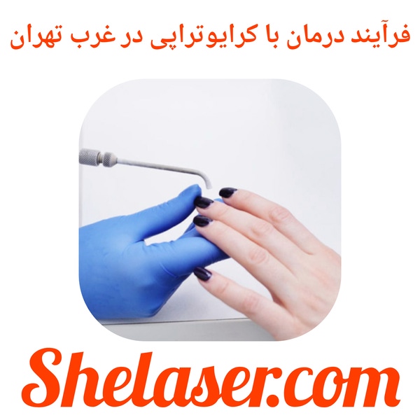 فرآیند درمان با کرایوتراپی در غرب تهران