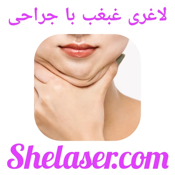 لاغری غبغب با جراحی