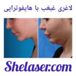 لاغری غبغب با هایفوتراپی