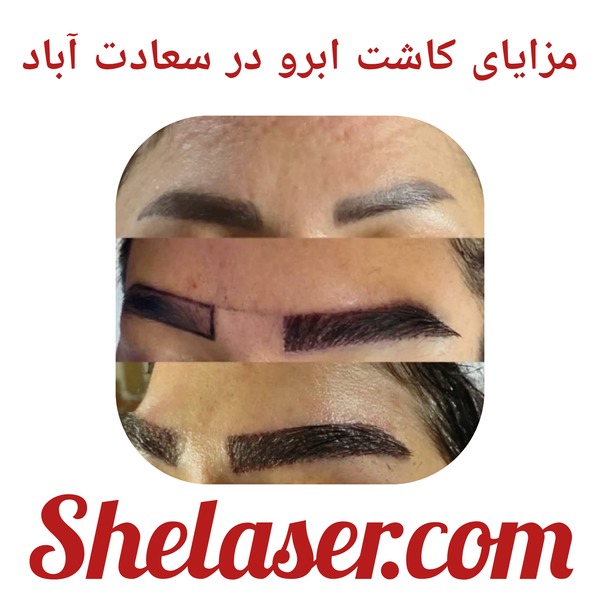 مزایای کاشت ابرو در سعادت آباد