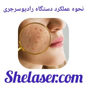 نحوه‌ عملکرد دستگاه رادیوسرجری