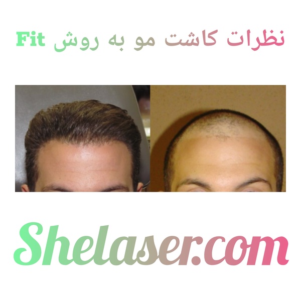 نظرات کاشت مو به روش FIT