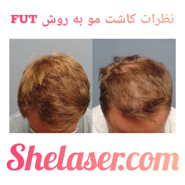 نظرات کاشت مو به روش FUT