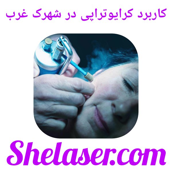 کاربرد کرایوتراپی در شهرک غرب