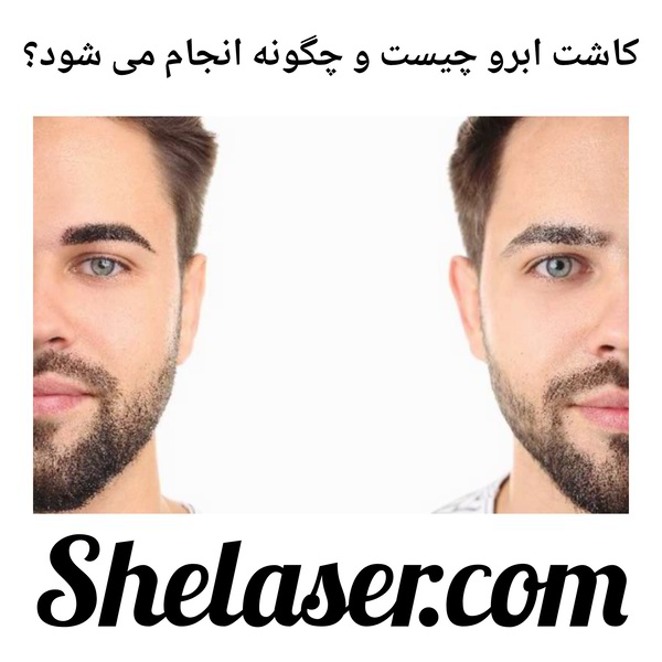 کاشت ابرو چیست و چگونه انجام می شود؟