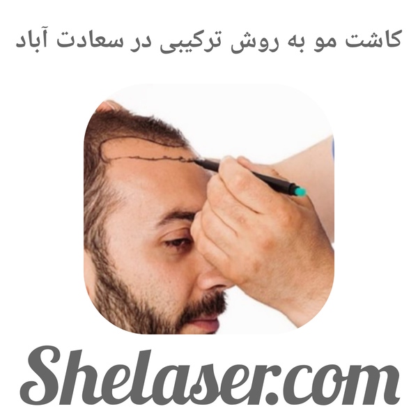 کاشت مو به روش ترکیبی در سعادت آباد