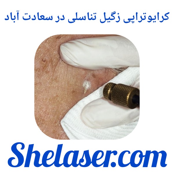 کرایوتراپی زگیل تناسلی در سعادت آباد